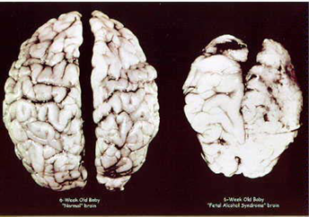 Six week old brains compaired: a normal brain and a 'fetal alcohol syndrome' brain